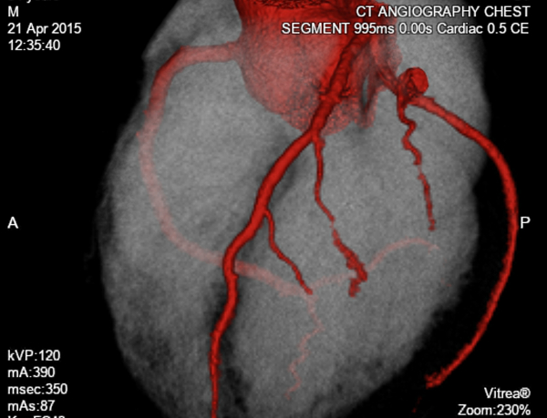 CT Coronary Angiography images