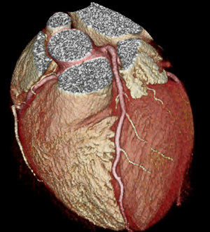 CT Coronary Angiography images