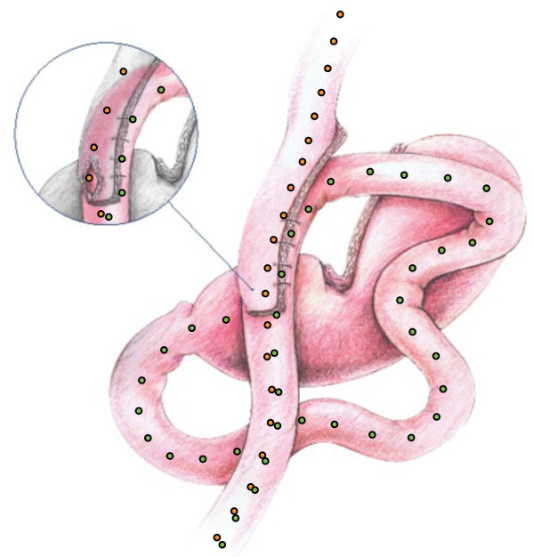 Omega Loop Gastric Bypass