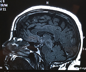 MRI brain